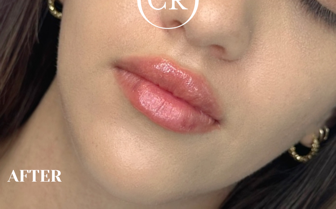 After - Before After (Image 1)