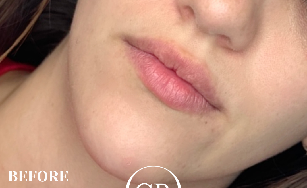 Before - Before After (Image 1)