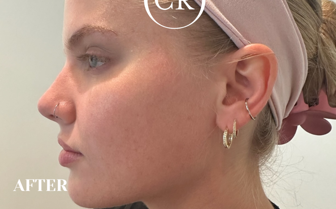 After - Before After (Image 2)