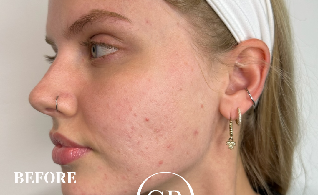 Before - Before After (Image 2)