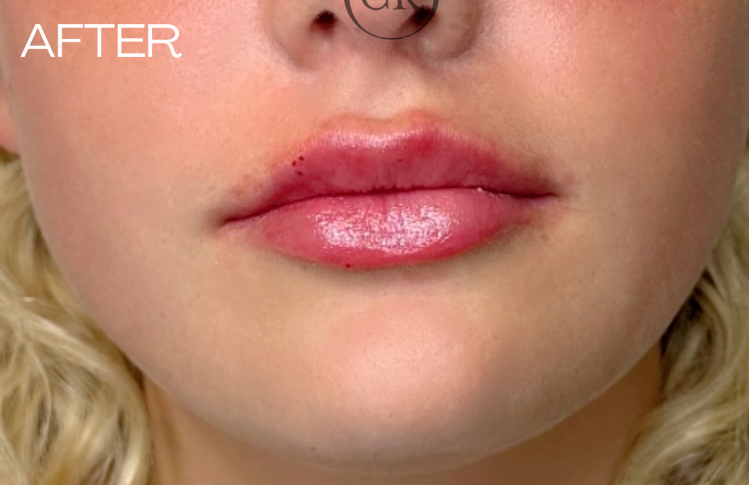 After - Before After (Image 3)