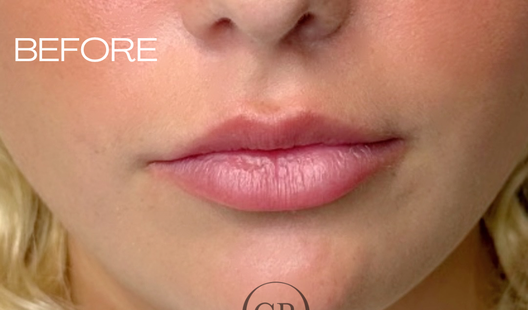 Before - Before After (Image 3)