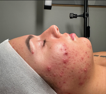 Acne Facial